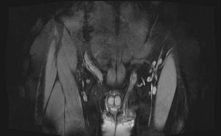 Anterior inferior iliac spine avulsion fracture (Radiopaedia 81312-95000 G 103).jpg