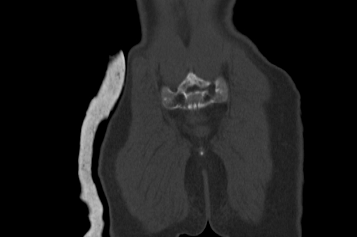 Anterior inferior iliac spine avulsion injury (Radiopaedia 88666-105376 Coronal bone window 64).jpg