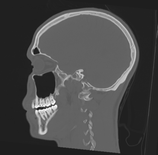 Anterior nasal spine fracture (Radiopaedia 46138-50494 Sagittal bone window 21).png