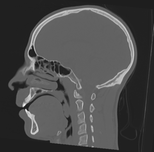 Anterior nasal spine fracture (Radiopaedia 46138-50494 Sagittal bone window 26).png