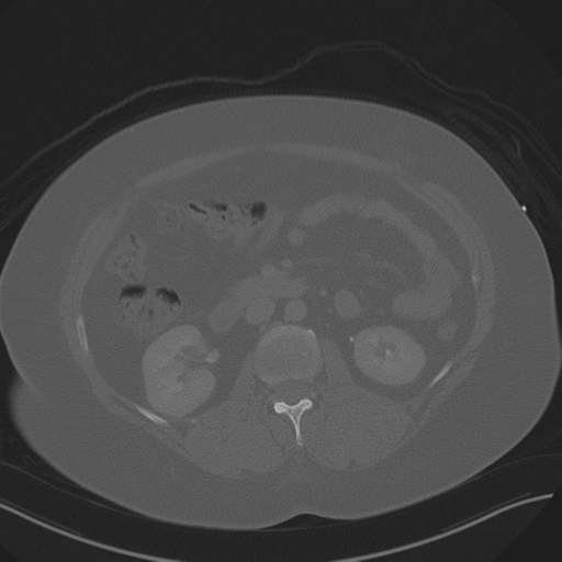 Anterior superior iliac spine avulsion fracture (Radiopaedia 44541-48244 Axial bone window 43).png