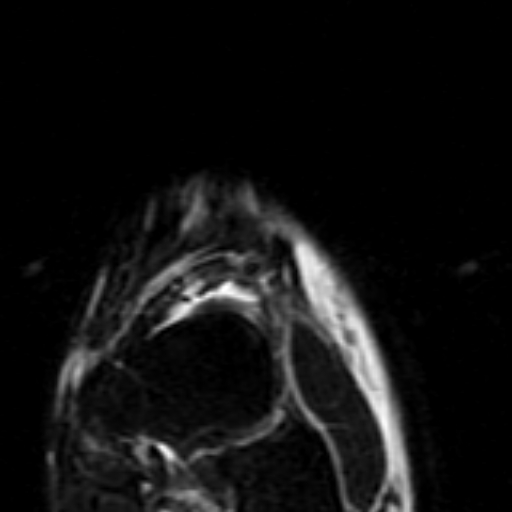 File:Anterior talofibular ligament rupture (Radiopaedia 15831-15484 Coronal STIR 1).jpg