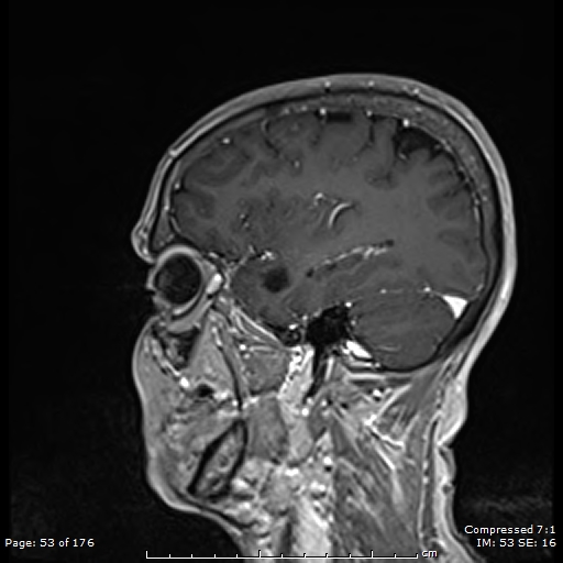 File:Anterior temporal lobe perivascular space (Radiopaedia 88283-104914 Sagittal T1 C+ 14).jpg