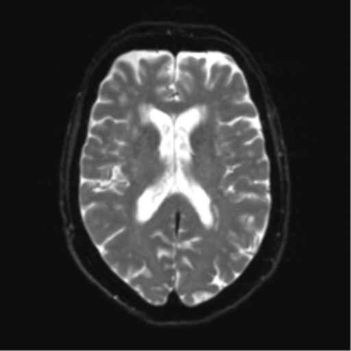 Anterior temporal pole cysts (Radiopaedia 46629-51102 Axial DWI 16).png