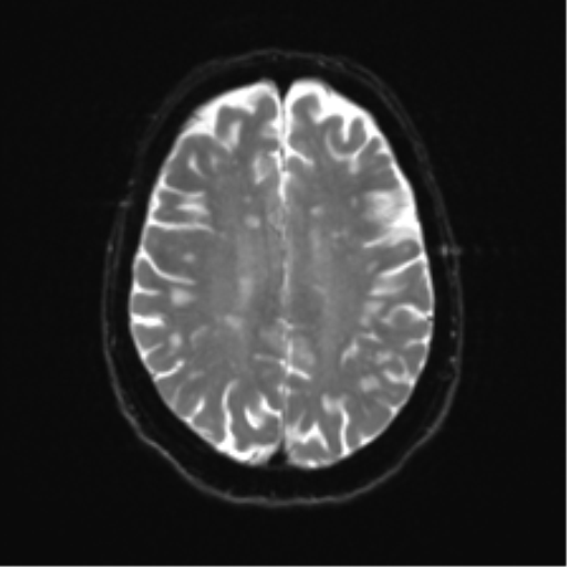 Anterior temporal pole cysts (Radiopaedia 46629-51102 Axial DWI 19).png