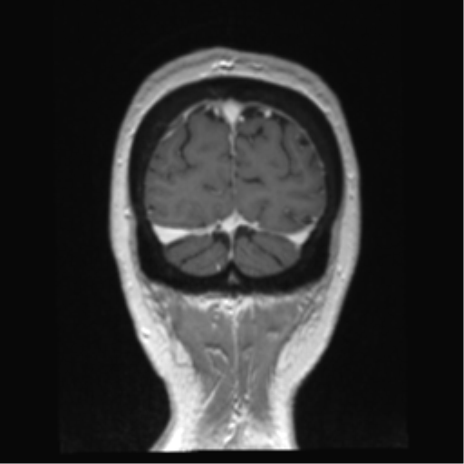 Anterior temporal pole cysts (Radiopaedia 46629-51102 Coronal T1 C+ 22).png