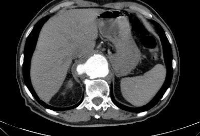 File:Anterior vertebral scalloping (abdominal aortic aneurysm) (Radiopaedia 66744-76067 F 4).jpg