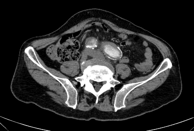 Anterior vertebral scalloping (abdominal aortic aneurysm) (Radiopaedia 66744-76067 F 66).jpg