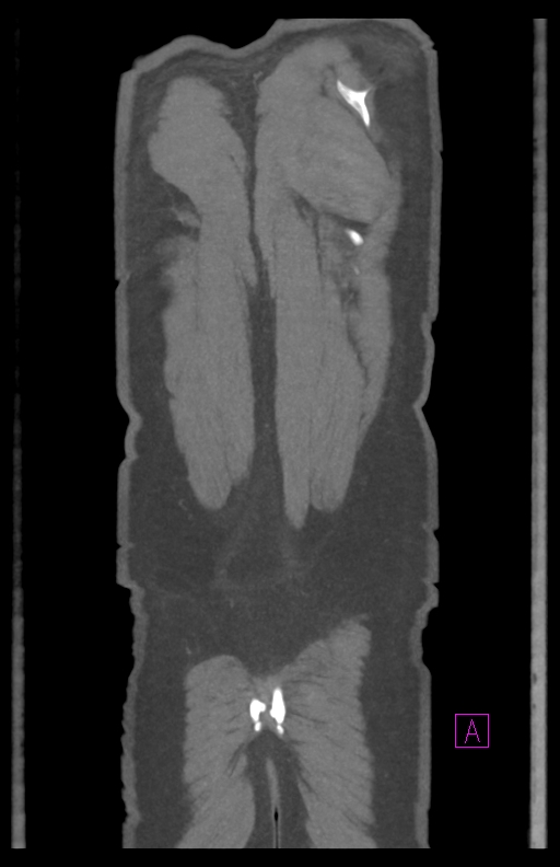Aortectomy and axillary-bifemoral bypass (Radiopaedia 28303-28545 C 88).jpg