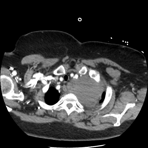 File:Aortic aneurysm and dissection - Stanford type A (Radiopaedia 36693-38261 A 11).png