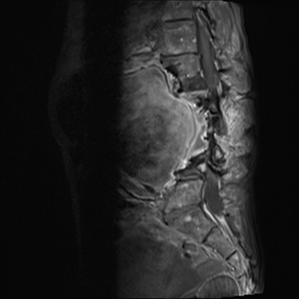 File:Aortic aneurysm with spinal destruction (Radiopaedia 42301-45409 Sagittal T1 fat sat 25).jpg