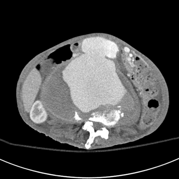 File:Aortic aneurysm with spinal destruction (Radiopaedia 42301-45410 A 48).jpg
