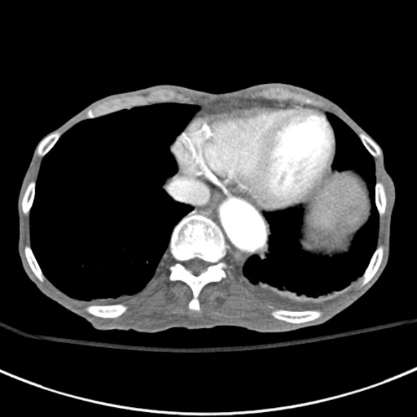 File:Aortic aneurysm with spinal destruction (Radiopaedia 42301-45410 A 6).jpg