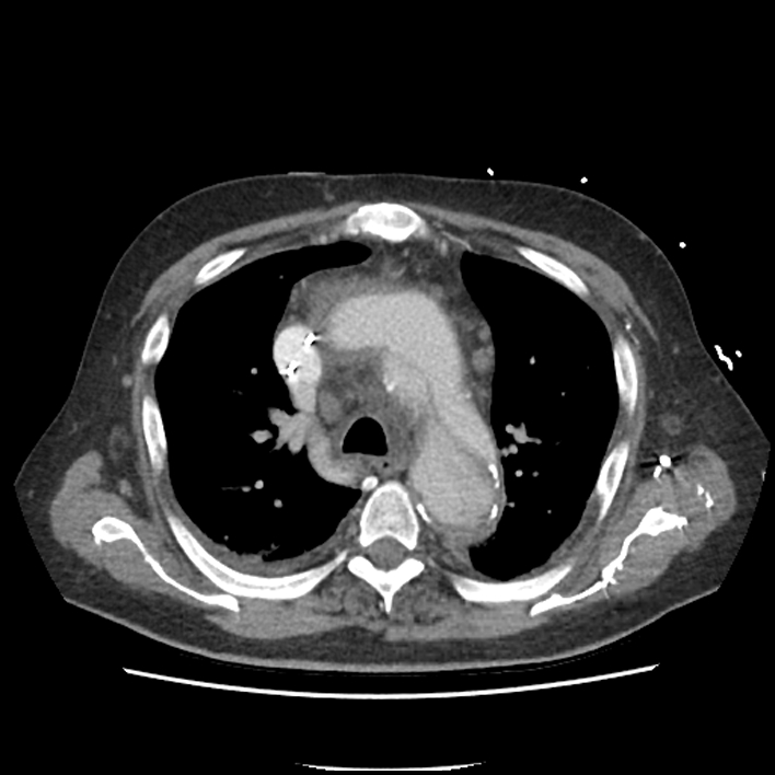 Aortic arch graft infection (FDG PET-CT) (Radiopaedia 71975-82437 A 18).jpg