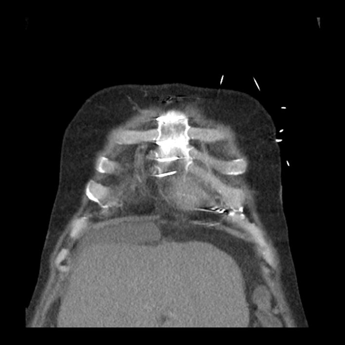 Aortic arch graft infection (FDG PET-CT) (Radiopaedia 71975-82437 Coronal 11).jpg