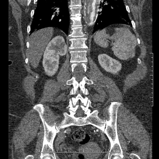 Aortic dissection- Stanford A (Radiopaedia 35729-37268 F 8).jpg