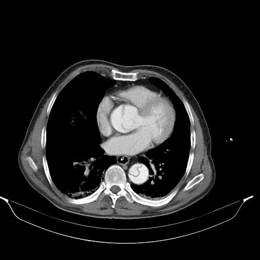 Aortic dissection- Stanford type A (Radiopaedia 22085-22085 A 26).jpg