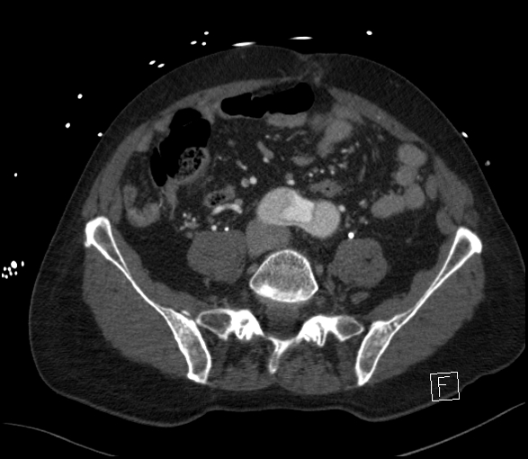 Aortic dissection (CTPA) (Radiopaedia 75506-86750 E 102).jpg
