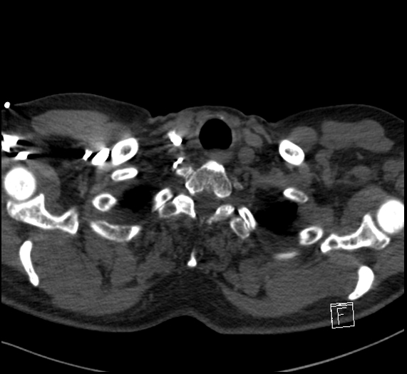 Aortic dissection (CTPA) (Radiopaedia 75506-86751 Axial C+ CTPA 8).jpg