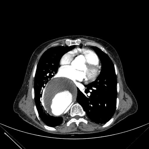 Aortic dissection (Radiopaedia 27466-27665 C+ arterial phase 160).jpg