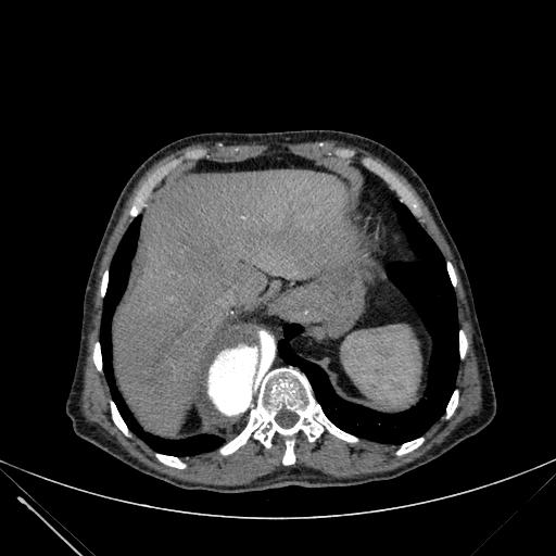Aortic dissection (Radiopaedia 27466-27665 C+ arterial phase 252).jpg