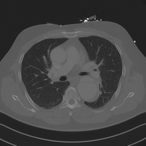 Aortic dissection (Radiopaedia 50763-56234 Axial bone window 49).png