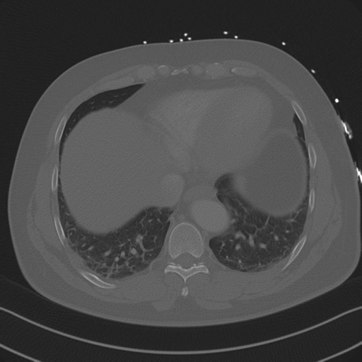 Aortic dissection (Radiopaedia 50763-56234 Axial bone window 78).png
