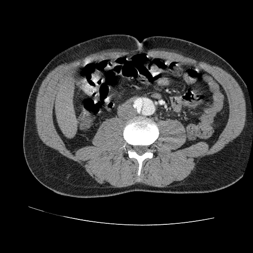 File:Aortic dissection - Stanford A -DeBakey I (Radiopaedia 28339-28587 B 150).jpg