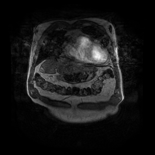 File:Aortic dissection - Stanford A - DeBakey I (Radiopaedia 23469-23551 D 27).jpg