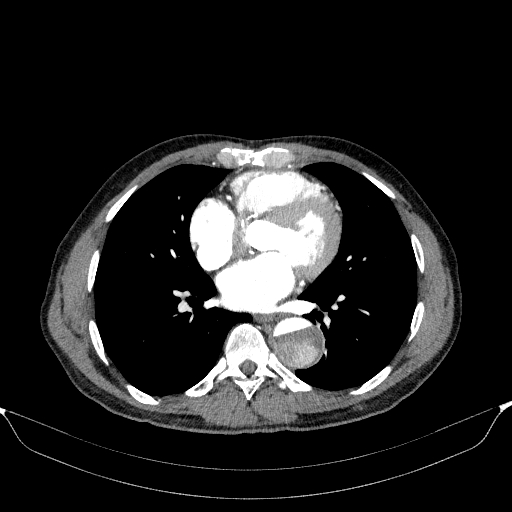 Aortic dissection - Stanford type A (Radiopaedia 83418-98500 A 38).jpg