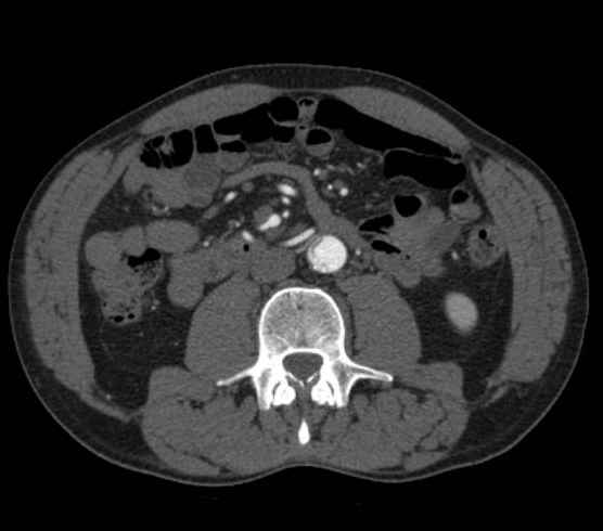 Aortic dissection - Stanford type B (Radiopaedia 73648-84437 A 169).jpg