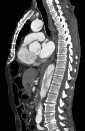 File:Aortic dissection - Stanford type B (Radiopaedia 73648-84437 C 74).jpg