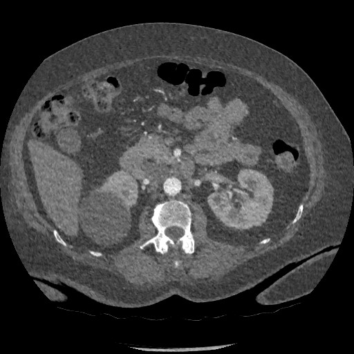Aortic dissection - Stanford type B (Radiopaedia 88281-104910 A 115).jpg