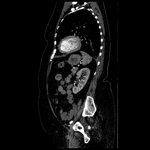 File:Aortic dissection - Stanford type B (Radiopaedia 88281-104910 C 64).jpg