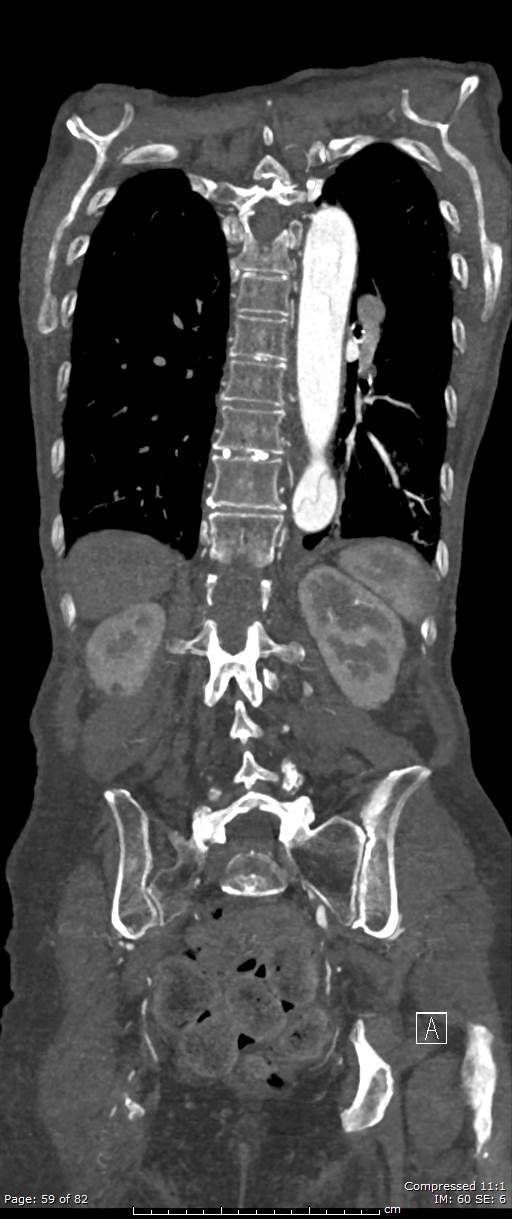 Aortic dissection with extension into aortic arch branches (Radiopaedia 64402-73204 A 59).jpg