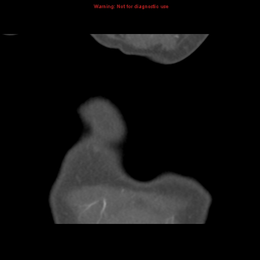 File:Aortic ductus diverticulum (Radiopaedia 8339-9180 B 2).jpg