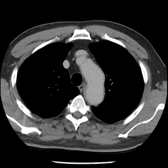 File:Aortic intramural hematoma (type B) (Radiopaedia 79323-92387 Axial C+ delayed 12).jpg