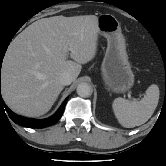 Aortic intramural hematoma (type B) (Radiopaedia 79323-92387 Axial C+ delayed 53).jpg
