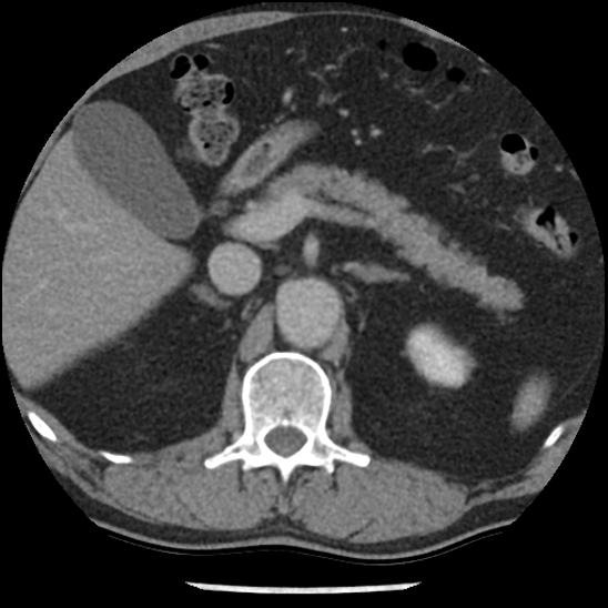 Aortic intramural hematoma (type B) (Radiopaedia 79323-92387 Axial C+ delayed 61).jpg