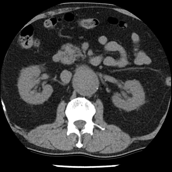 Aortic intramural hematoma (type B) (Radiopaedia 79323-92387 Axial non-contrast 66).jpg