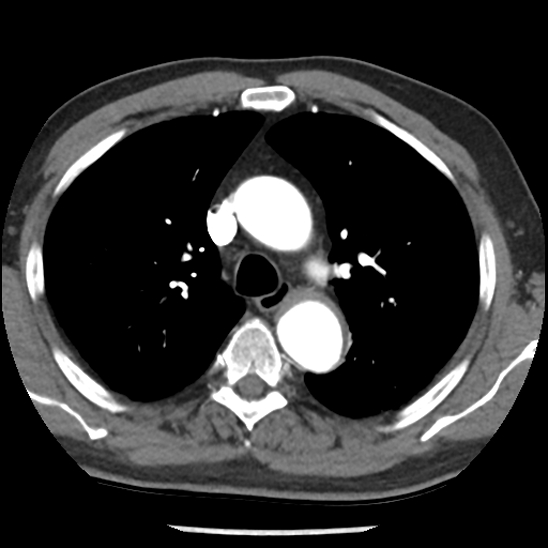 File:Aortic intramural hematoma (type B) (Radiopaedia 79323-92387 B 17).jpg
