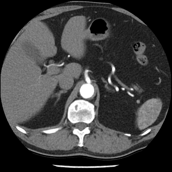Aortic intramural hematoma (type B) (Radiopaedia 79323-92387 B 57).jpg
