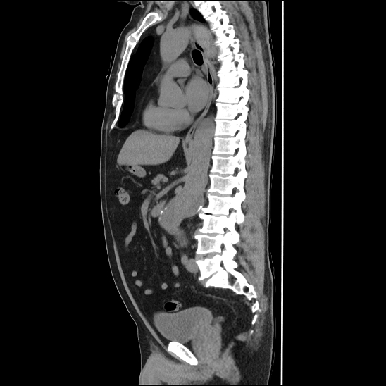 Aortic intramural hematoma (type B) (Radiopaedia 79323-92387 G 27).jpg