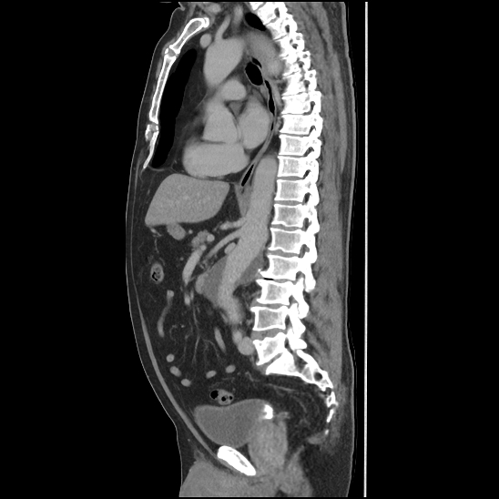 Aortic intramural hematoma (type B) (Radiopaedia 79323-92387 Sagittal C+ delayed 27).jpg