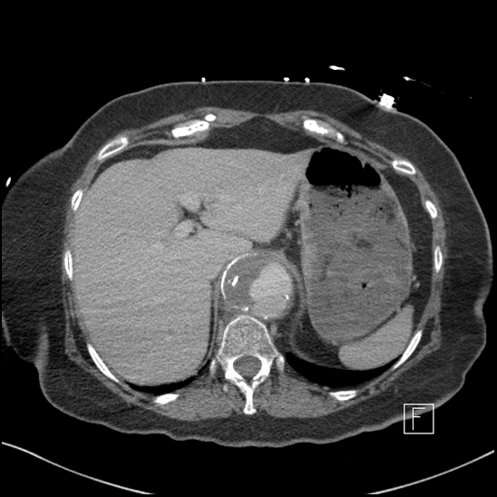File:Aortic intramural hematoma with dissection and intramural blood pool (Radiopaedia 77373-89491 E 2).jpg
