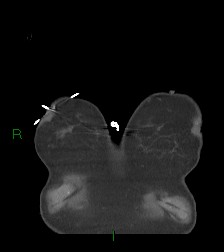 File:Aortic valve endocarditis (Radiopaedia 87209-103485 D 70).jpg