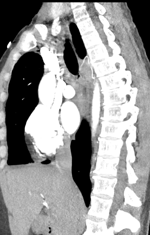 Aortic valve non-coronary cusp thrombus (Radiopaedia 55661-62189 C+ arterial phase 34).png