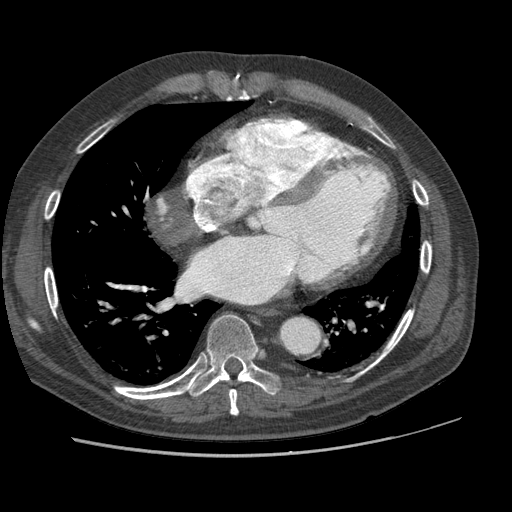 File:Aorto-coronary bypass graft aneurysms (Radiopaedia 40562-43157 A 78).png