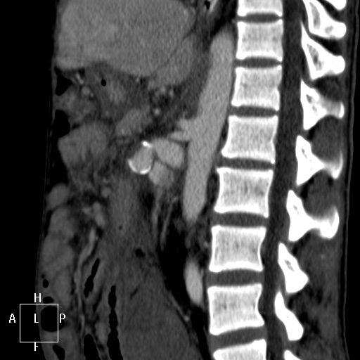 Aorto-left renal vein fistula (Radiopaedia 45534-49628 C 36).jpg