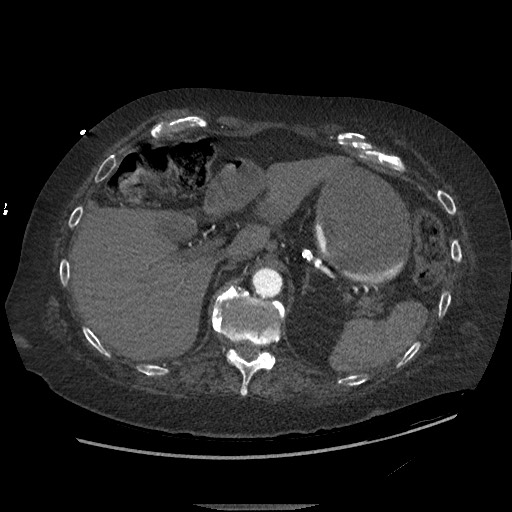 Aortoesophageal fistula with endovascular repair (Radiopaedia 73781-84592 Axial C+ CTPA 174).jpg